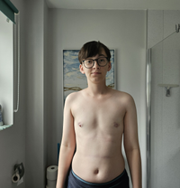 A front-on photo of the author, where his chest can be seen in full.  Scarring is visible around the nipples if you look closely.